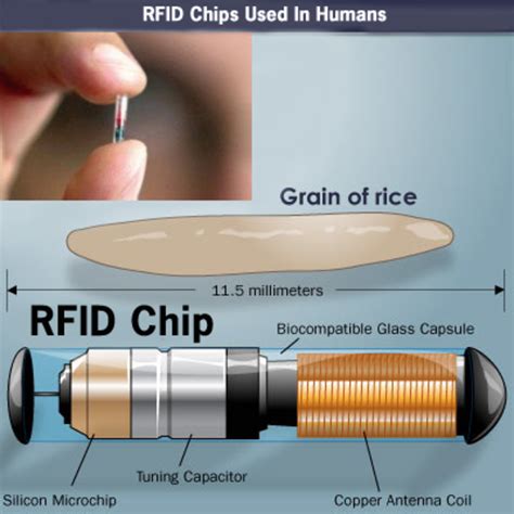 rfid chip implant removal|What Kind of Surgery Would Be Necessary to Remove an RFID .